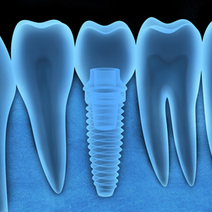 A dental implant post with a crown on it